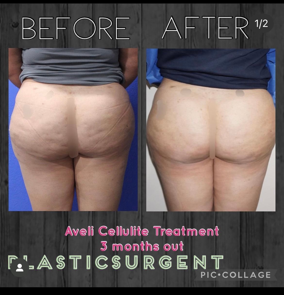 cellulite treatments that work