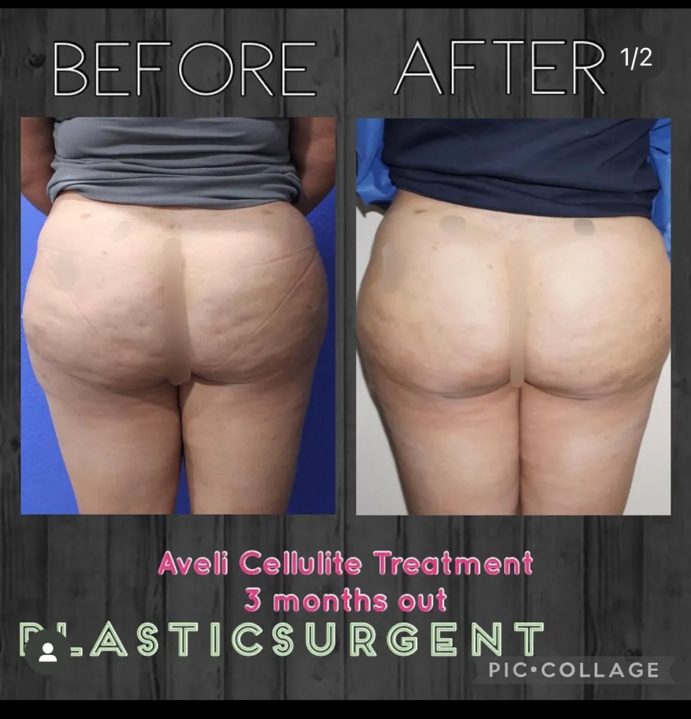 Cellulite reduction treatments