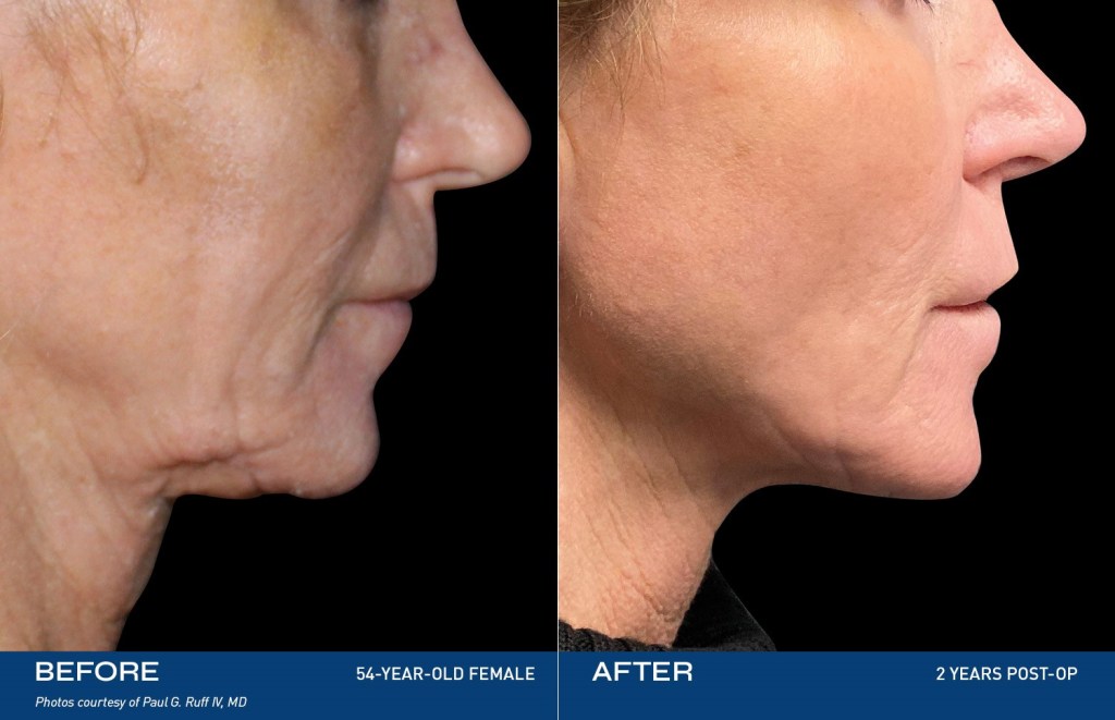 Renuvion Skin Tightening Irvine  Non-Surgical Face & Body Lipo
